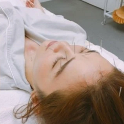 Curso de Acupuntura estética sevilla